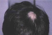 lice biteపేను కొరుకుడు పేను కొరుకుడు Penu korukudu